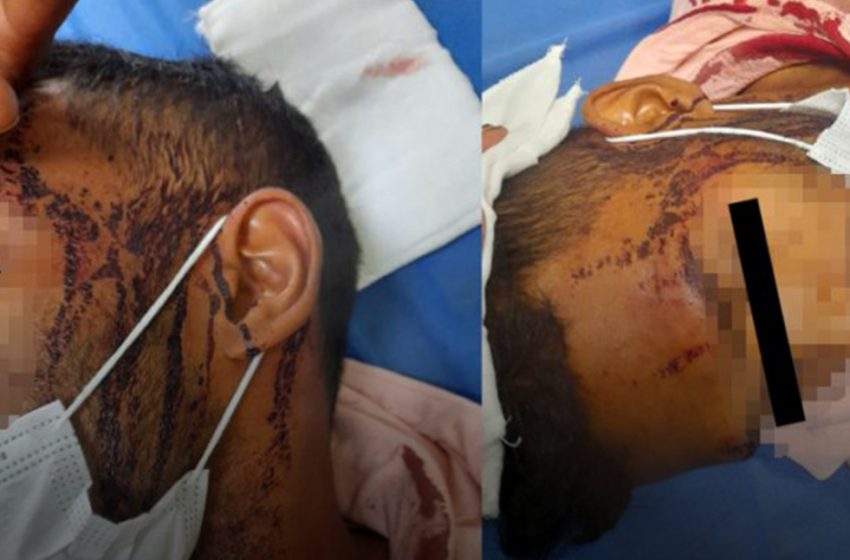  «Le aplastaron la cabeza»: Pareja gay fue atacada por 10 sujetos en pleno centro de Santiago
